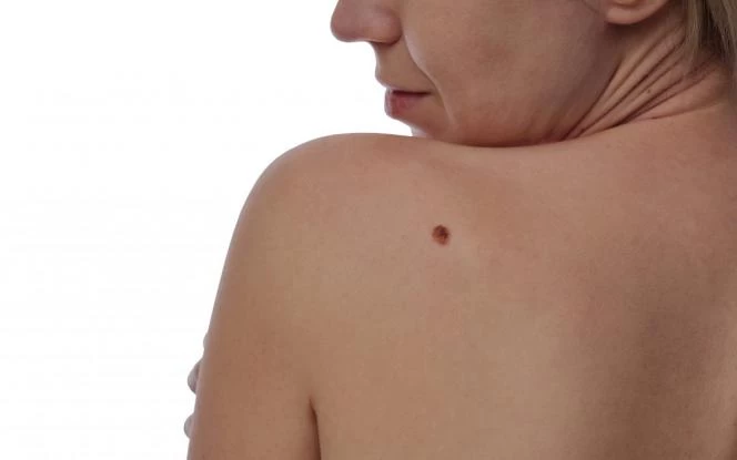 Πως εμφανίζεται το μελάνωμα – Με τι μοιάζουν οι ύποπτες ελιές